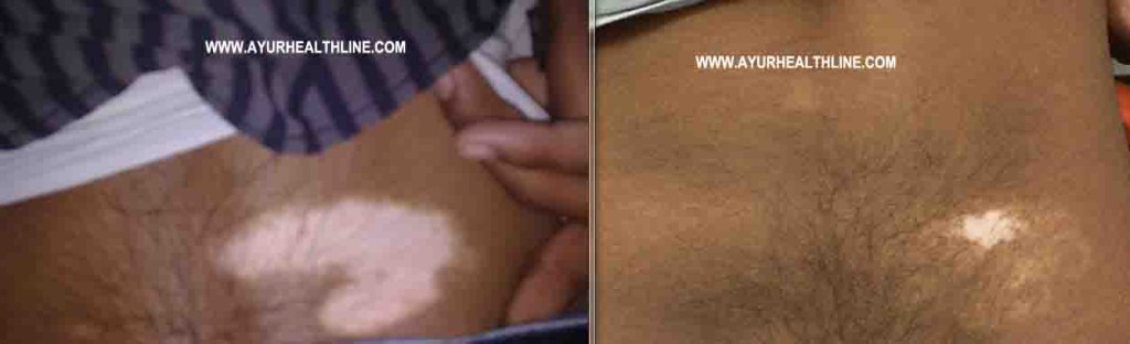 Vitiligo Treatment Results