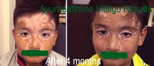 Latest Vitiligo Treatment