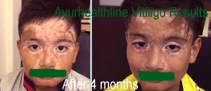 Leucoderma and Vitiligo in Youngsters – Leucoderma Consciousness Weblog