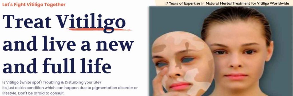 Natural vitiligo treatment, Herbal vitiligo treatment, herbs for vitiligo